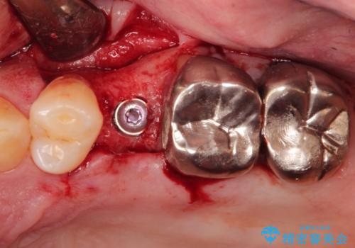 小臼歯部のインプラントの治療中