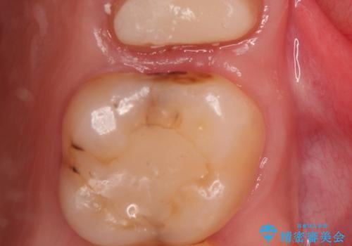 歯肉の中までの深い虫歯　部分矯正後のセラミック治療の治療中