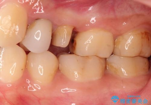 歯肉の中までの深い虫歯 部分矯正後のセラミック治療の治療中