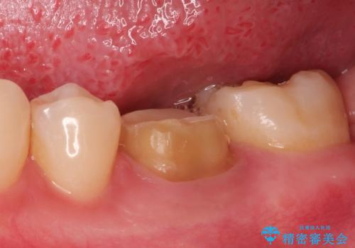 銀歯を白くしたい セラミッククラウンの治療中