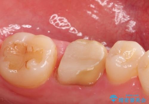 銀歯を白くしたい セラミッククラウンの治療中