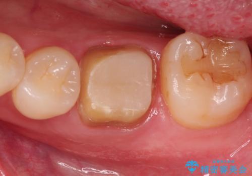 銀歯を白くしたい セラミッククラウンの治療中