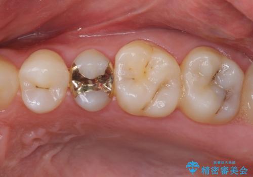 他院で治療中の歯　ゴールドインレーによる修復治療の症例 治療後
