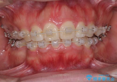 がたがたと出っ歯を直したい ワイヤーによる抜歯矯正の治療中