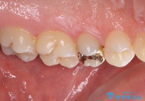 他院で治療中の歯 ゴールドインレーによる修復治療の治療後