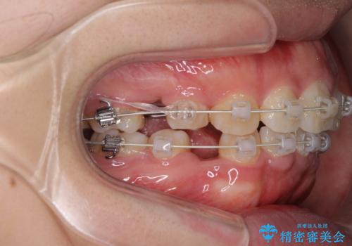 がたがたと出っ歯を直したい ワイヤーによる抜歯矯正の治療中