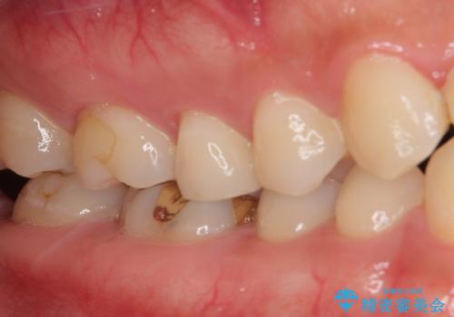 他院で治療中の歯 ゴールドインレーによる修復治療の治療後