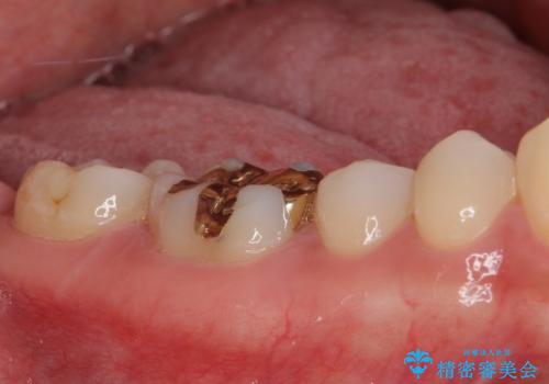 他院で治療中の歯 ゴールドインレーによる修復治療の治療後