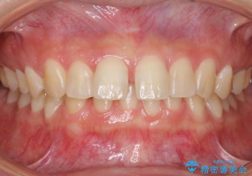 前歯のすきま　右上の小臼歯の垂直的骨吸収を抜歯で解決の症例 治療前