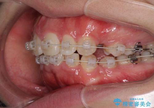 がたがたと出っ歯を直したい ワイヤーによる抜歯矯正の治療中