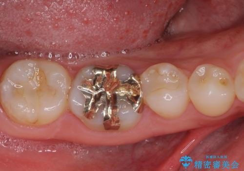 他院で治療中の歯　ゴールドインレーによる修復治療の治療後