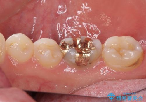 他院で治療中の歯 ゴールドインレーによる修復治療の治療後