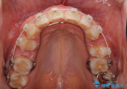 がたがたと出っ歯を直したい ワイヤーによる抜歯矯正の治療中