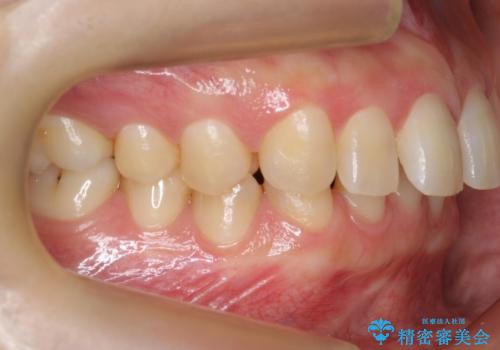 前歯のすきま 右上の小臼歯の垂直的骨吸収を抜歯で解決の治療前