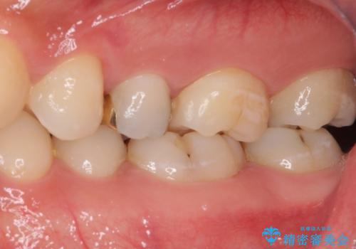 他院で治療中の歯 ゴールドインレーによる修復治療の治療後