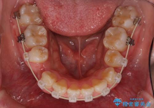 がたがたと出っ歯を直したい ワイヤーによる抜歯矯正の治療中