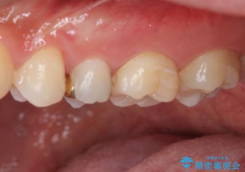 他院で治療中の歯 ゴールドインレーによる修復治療の治療後