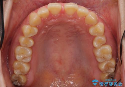 前歯のすきま 右上の小臼歯の垂直的骨吸収を抜歯で解決の治療前