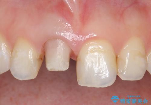 オールセラミッククラウン(スペシャル) 変色が気になる前歯部の補綴の治療中