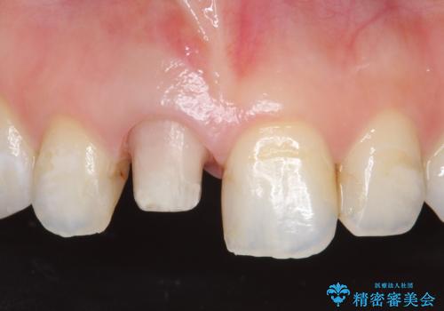 オールセラミッククラウン(スペシャル) 変色が気になる前歯部の補綴の治療中