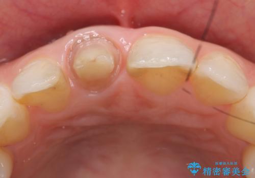 オールセラミッククラウン(スペシャル) 変色が気になる前歯部の補綴の治療中