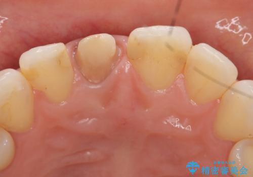オールセラミッククラウン(スペシャル)　変色が気になる前歯部の補綴の治療中