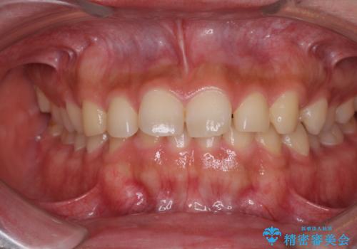 インビザラインによる、すきっ歯の改善の症例 治療前