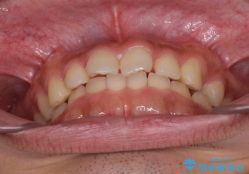 インビザラインによる、すきっ歯の改善の治療前