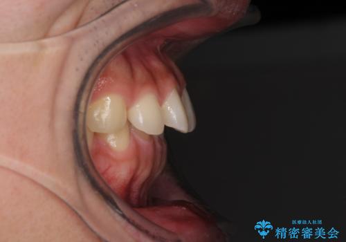 インビザラインによる、すきっ歯の改善の治療前