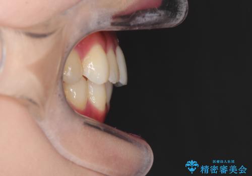 前歯のガタガタを目立たない装置でなおしたい インビザラインによる目立たない矯正の治療後