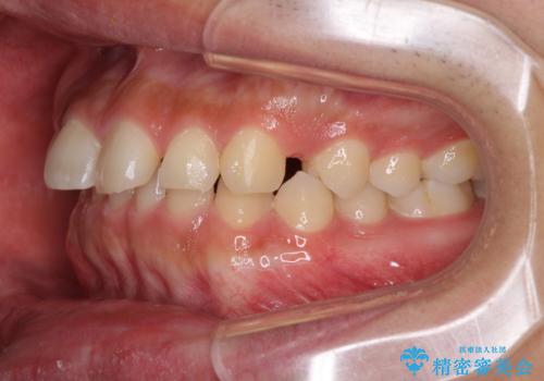 インビザラインによる、すきっ歯の改善の治療前