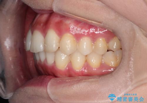 前歯のガタガタを目立たない装置でなおしたい　インビザラインによる目立たない矯正の治療後
