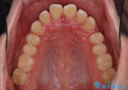 インビザラインによる、すきっ歯の改善の治療前