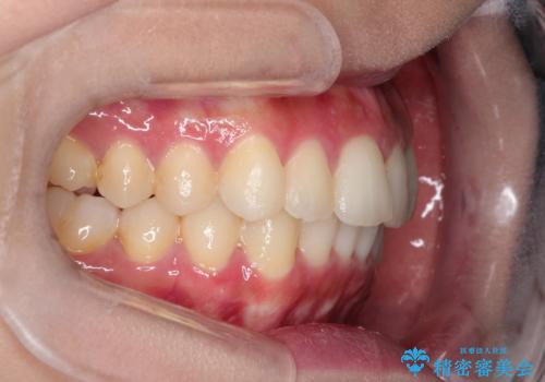 前歯のガタガタを目立たない装置でなおしたい インビザラインによる目立たない矯正の治療後