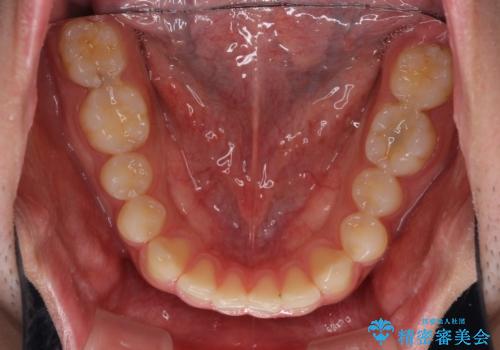 インビザラインによる、すきっ歯の改善の治療前