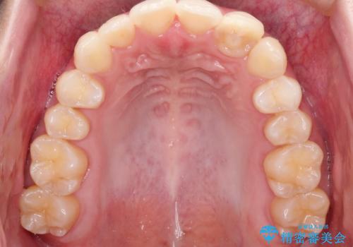 前歯のガタガタを目立たない装置でなおしたい インビザラインによる目立たない矯正の治療後