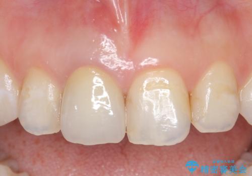 オールセラミッククラウン(スペシャル)　変色が気になる前歯部の補綴の治療後