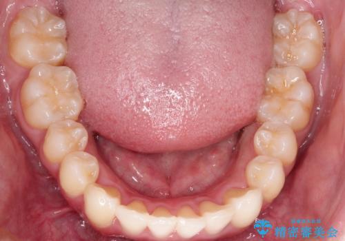 前歯のガタガタを目立たない装置でなおしたい インビザラインによる目立たない矯正の治療後