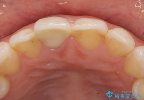 オールセラミッククラウン(スペシャル) 変色が気になる前歯部の補綴の治療後