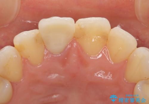 オールセラミッククラウン(スペシャル)　変色が気になる前歯部の補綴の治療後