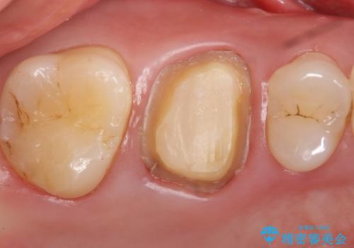 メタルボンドクラウン ゴールドから白い歯への治療中