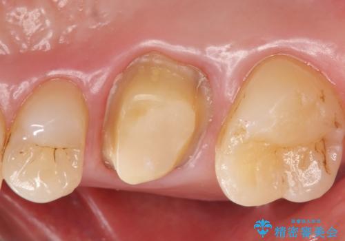 メタルボンドクラウン ゴールドから白い歯への治療中