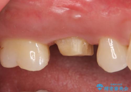 メタルボンドクラウン ゴールドから白い歯への治療中
