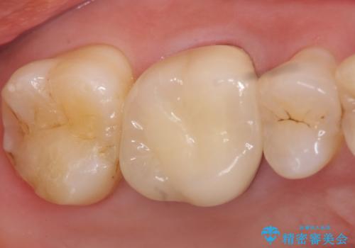 メタルボンドクラウン ゴールドから白い歯への治療後