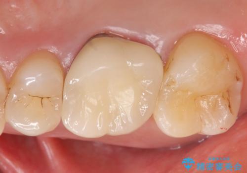 メタルボンドクラウン ゴールドから白い歯への治療後