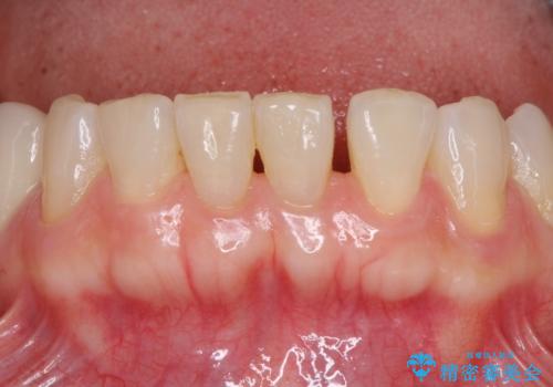 飛行機を利用しての通院 気になる所を全て治療する総合歯科治療の治療前