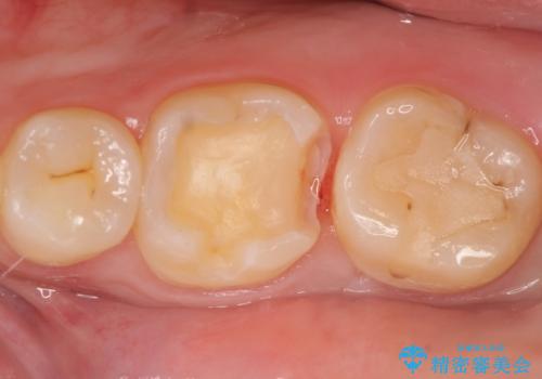 セラミックインレー 虫歯治療の治療中