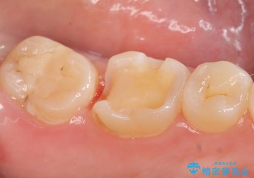 セラミックインレー 虫歯治療の治療中
