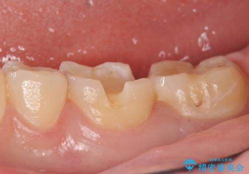 セラミックインレー 虫歯治療の治療中