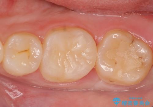 セラミックインレー 虫歯治療